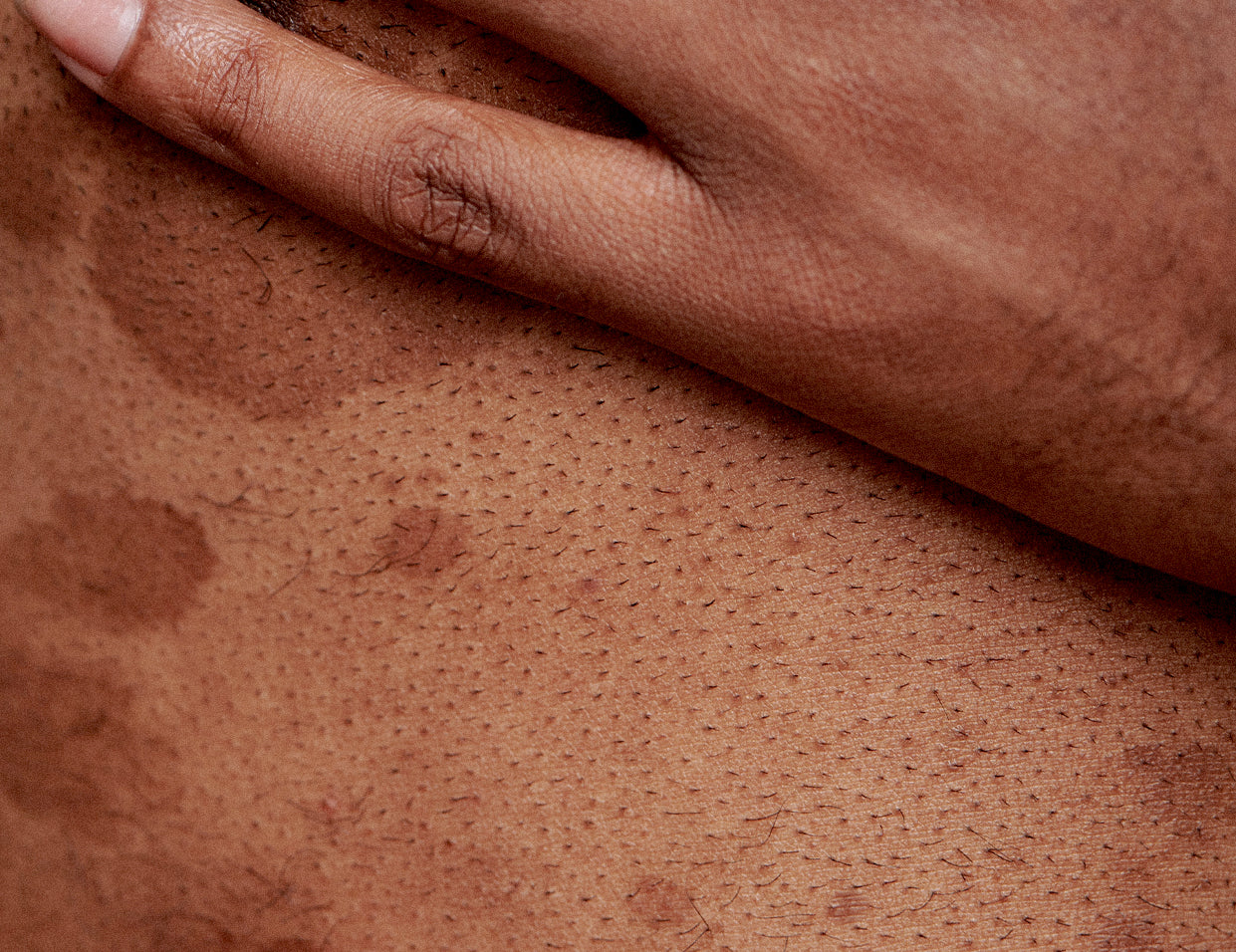 body hyperpigmentation