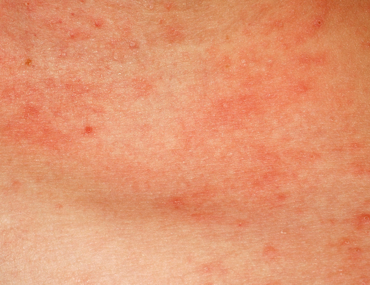 sensitive skin type