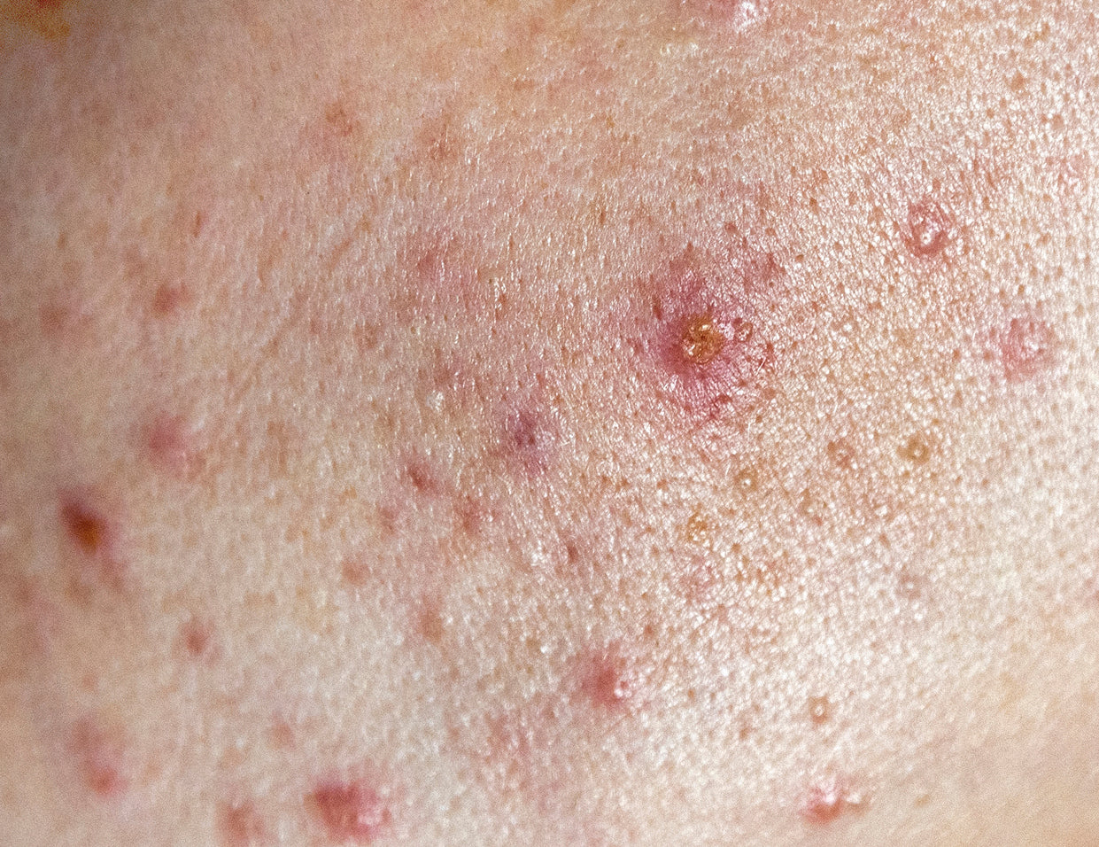 acne-prone skin type